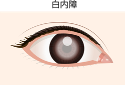 白内障イラスト
