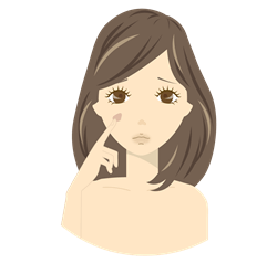 肝斑イラスト