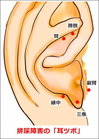 排尿障害の耳ツボ