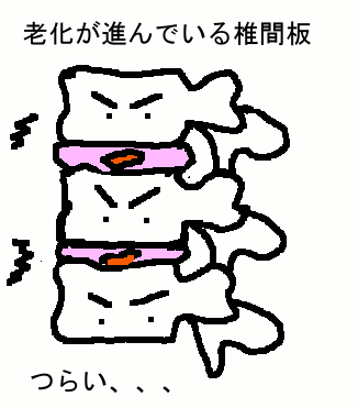 老化した椎間板