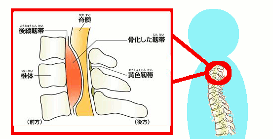 後縦靱帯骨化症の説明図