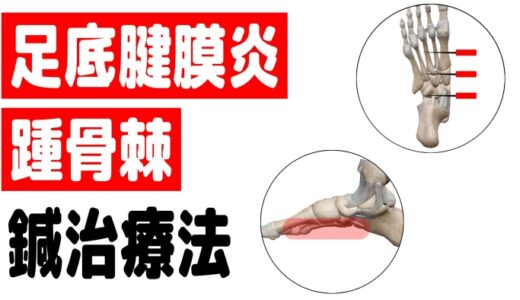 足底腱膜炎（足裏の痛み・踵骨棘）の鍼治療法