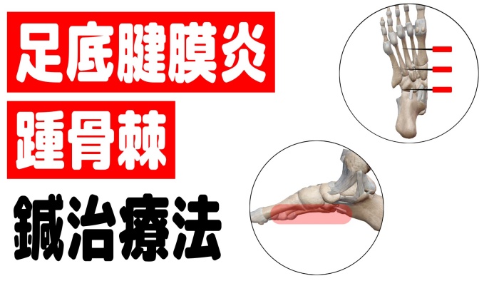 足の骨棘の予防